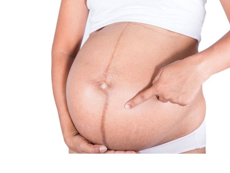 linea nigra su donna incinta