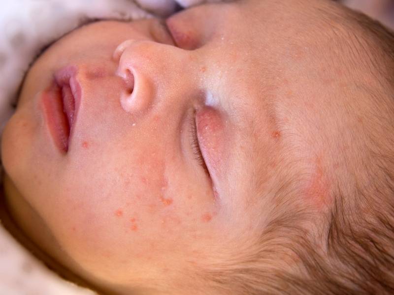 Bambino con acne neonatale