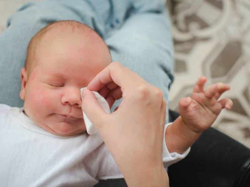 Bambino con la stenosi del dotto lacrimale